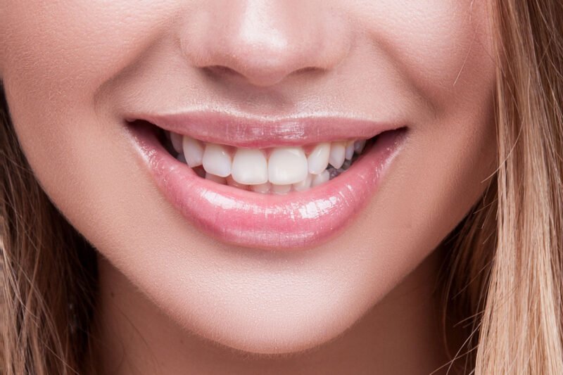 After — Teeth Whitening