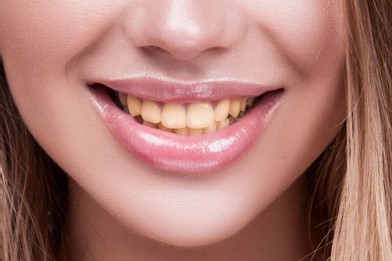 Before — Teeth Whitening